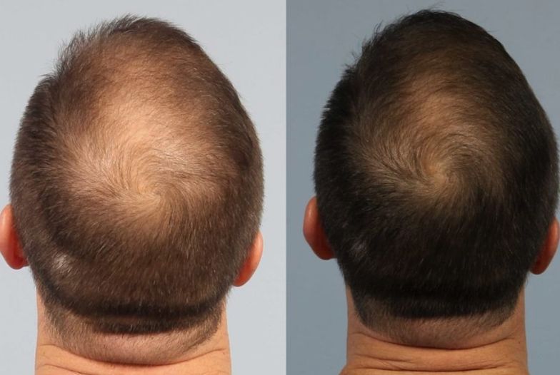 Before &After
